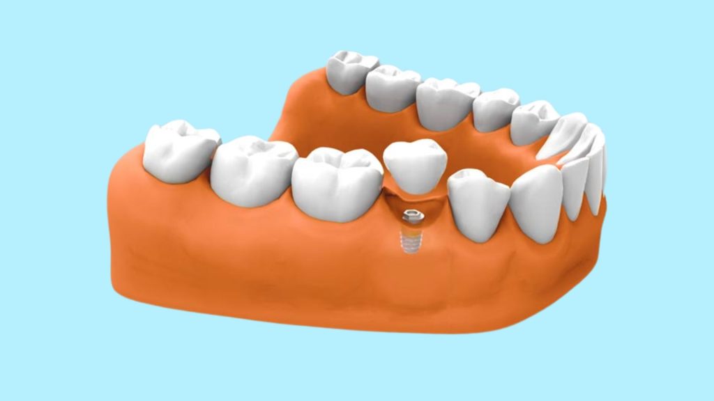 implantologia implantes dentales