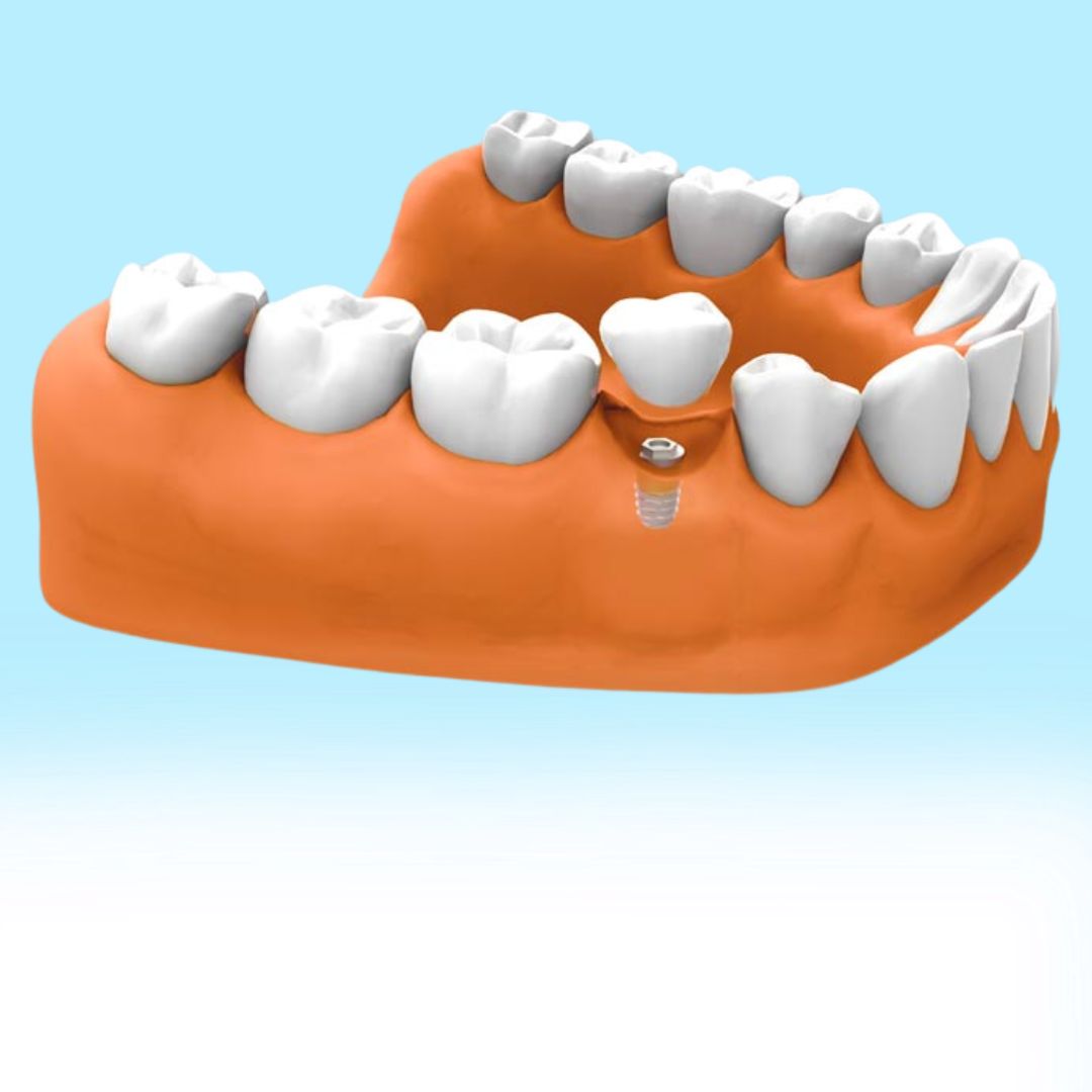 Servicios Odontologicos implantes dentales