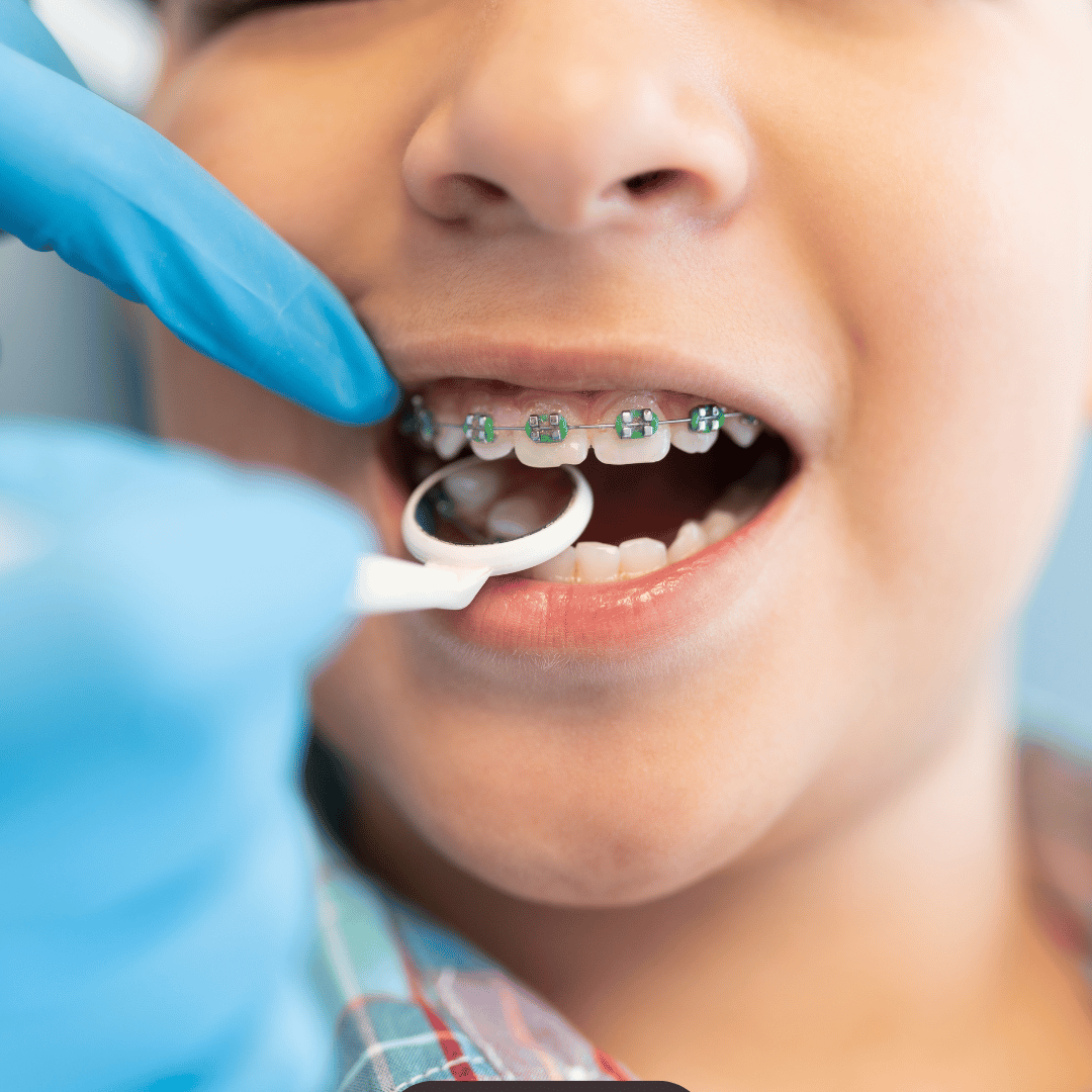 Servicios odontologicos Ortodoncia con brackets